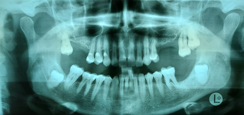 Zahnarzt Götte Pirmasens Orale Ästhetik Funktion Fortgeschrittene Knochenabbau