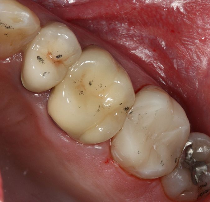 Zahnarzt Götte Pirmasens Orale Ästhetik Funktion Wurzelkanalbehandlung